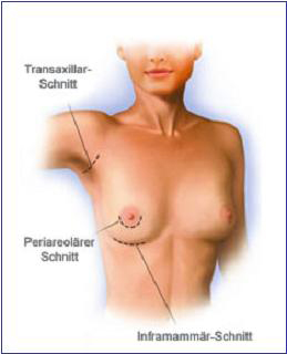 Hautschnitte bei der Brustvergrößerung